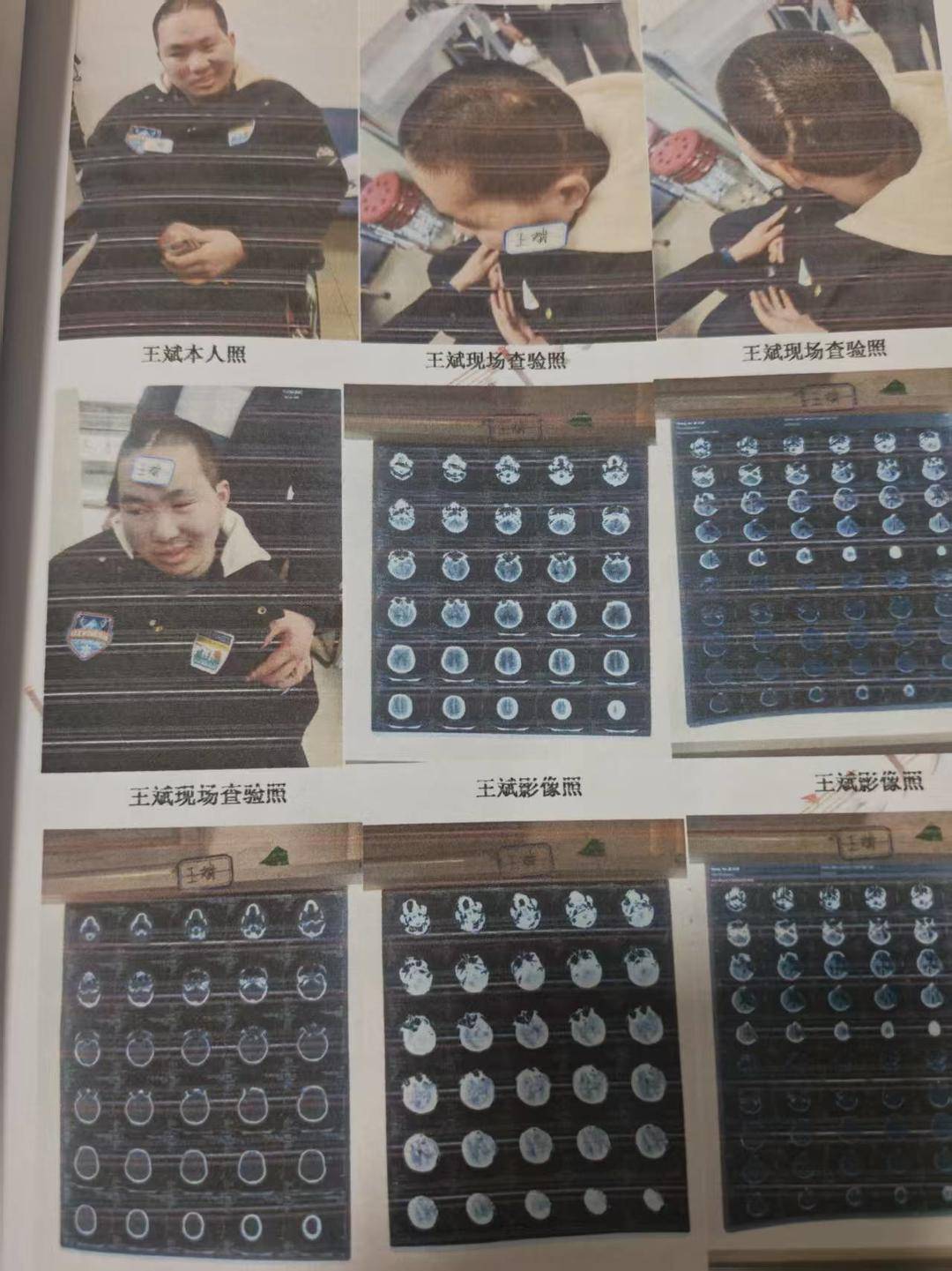 被撞碎的人生:23岁研究生被16岁少年无证驾车撞致颅脑损伤,亲属称其如今心智如幼童